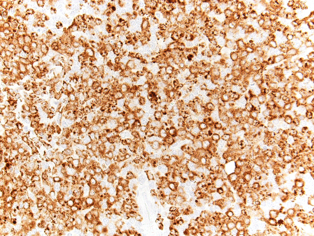 Lymph node biopsy, myeloid-predominant area, MPO